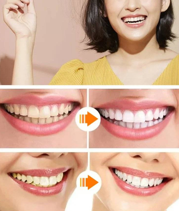 進口美白仿真牙套 進口美白仿真牙套